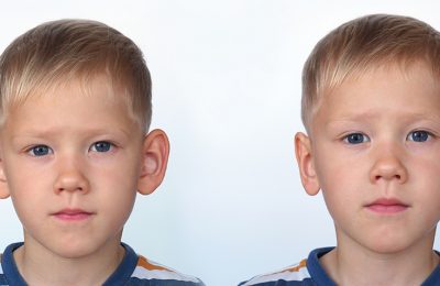 OREJAS ANTES Y DESPUES