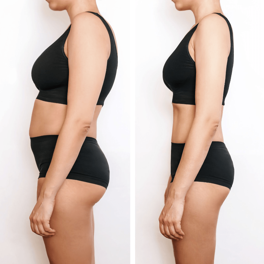 Lipo Vaser antes y después